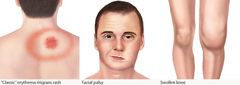 Lyme disease description [DCHealth]