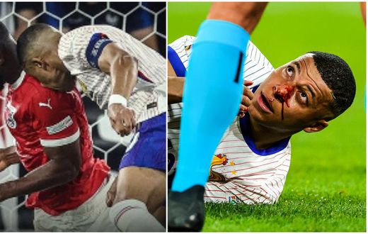 Video: Mbappe sustains broken nose from clash of heads with Kevin Danso