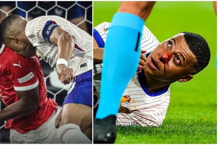 Video: Mbappe sustains broken nose from clash of heads with Kevin Danso