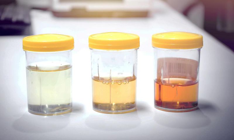 Urine sample