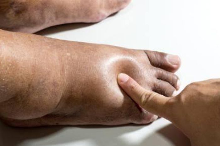 Leg swelling is also known as edema [Shutterstock]