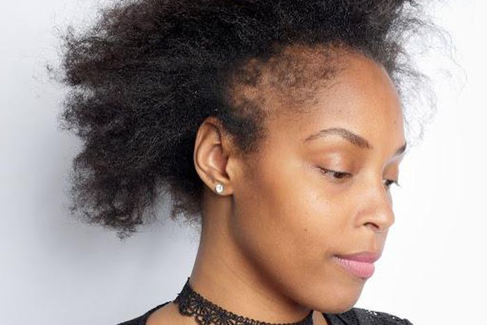 Postpartum hair loss: Causes & what to do about it