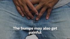 How to know if the rash on your penis is from HIV