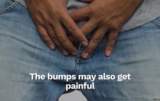 How to know if the rash on your penis is from HIV