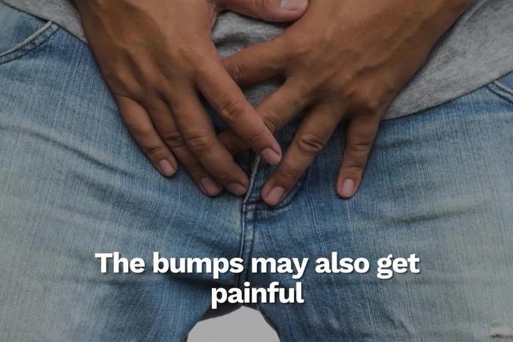 How to know if the rash on your penis is from HIV