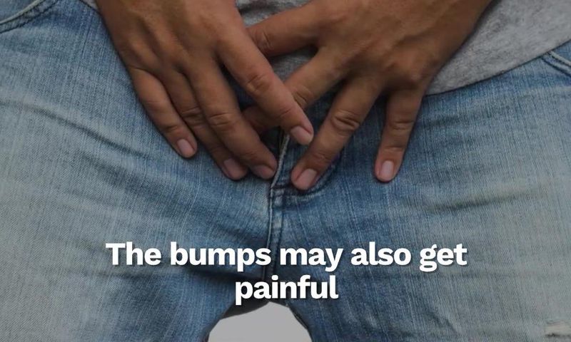 How to know if the rash on your penis is from HIV