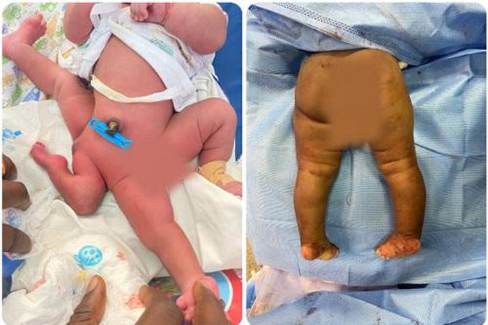 KATH doctors conduct 6-hour successful surgery on 5-month-old baby born with 4 legs