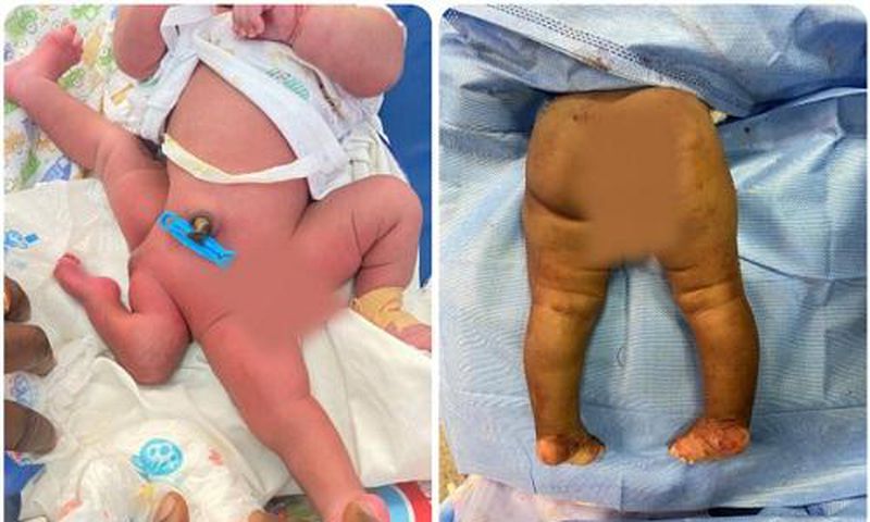 KATH doctors conduct 6-hour successful surgery on 5-month-old baby born with 4 legs