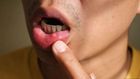 Mouth ulcer