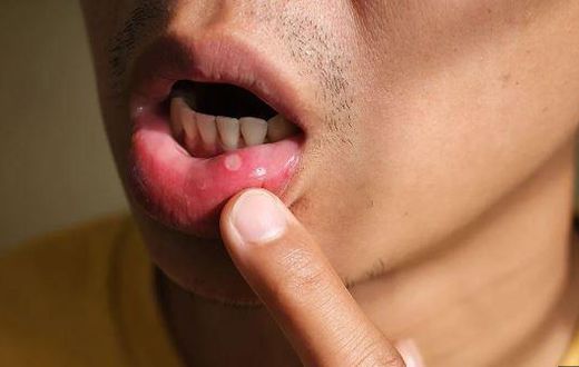 Mouth ulcer