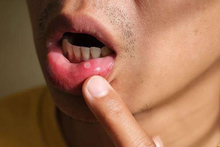 Mouth ulcer