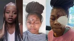 Lady loses one eye after attack by a man whose advances she rejected