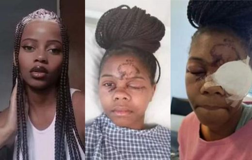 Lady loses one eye after attack by a man whose advances she rejected