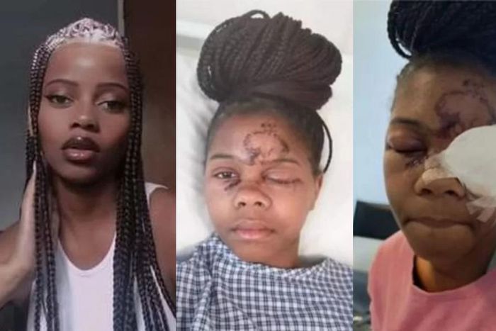 Lady loses one eye after attack by a man whose advances she rejected