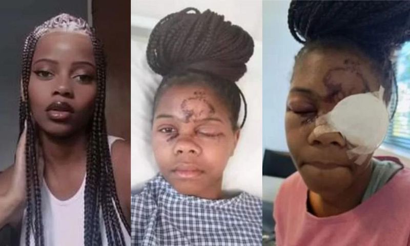 Lady loses one eye after attack by a man whose advances she rejected