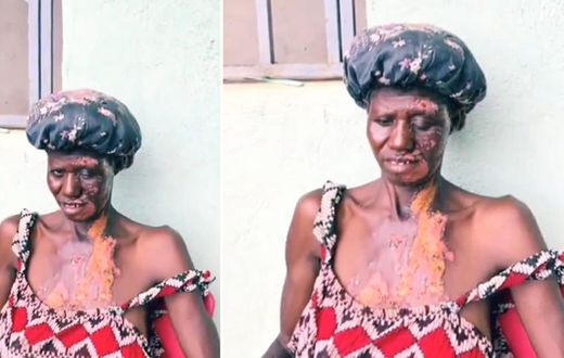 Mother left with severe burns after 14-year-old daughter poured hot water on her