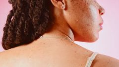 Why do skin tags develop? [Self]