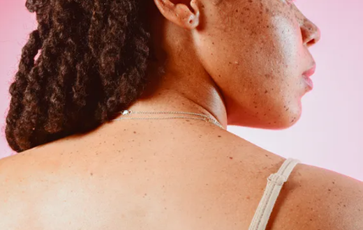 Why do skin tags develop? [Self]
