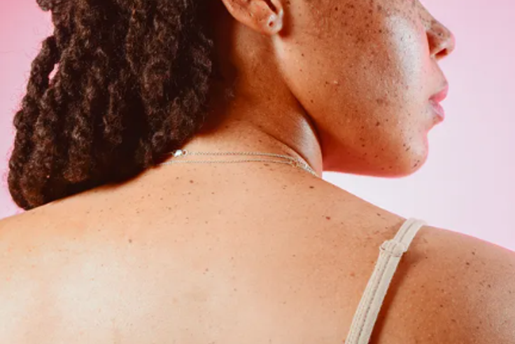 Why do skin tags develop? [Self]