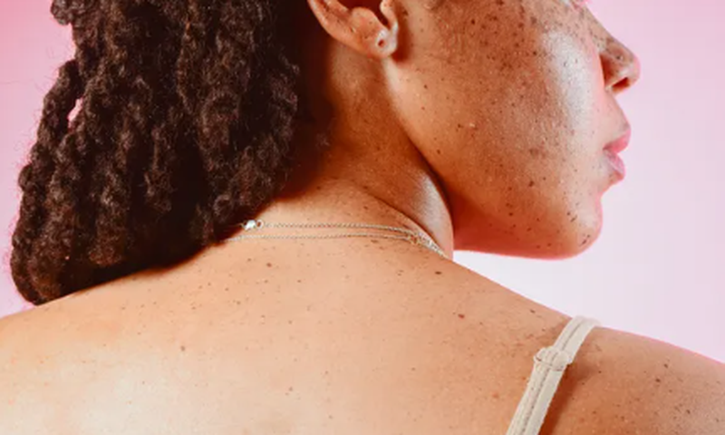 Why do skin tags develop? [Self]