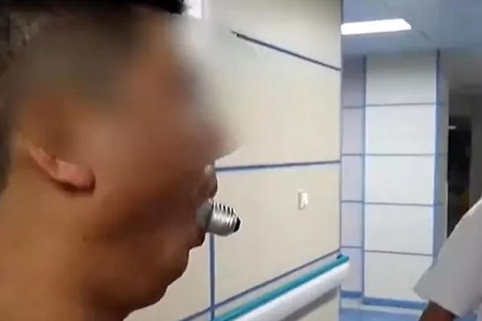 Doctors dislocate man’s jaw to remove light bulb stuck in his mouth in online challenge