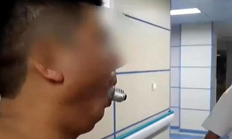 Doctors dislocate man’s jaw to remove light bulb stuck in his mouth in online challenge