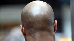 Baldness