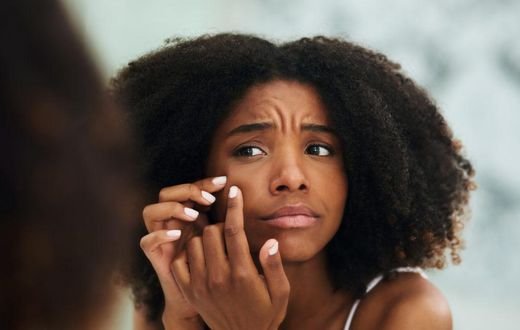5 healthy home remedies of getting rid of acne scars and pimple marks