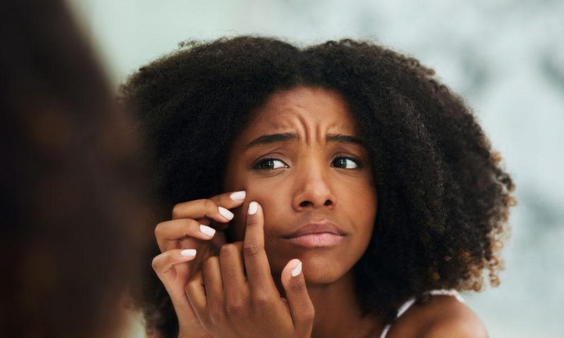 5 healthy home remedies of getting rid of acne scars and pimple marks