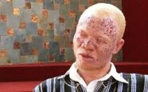 114 albinos have disappeared in Mozambique