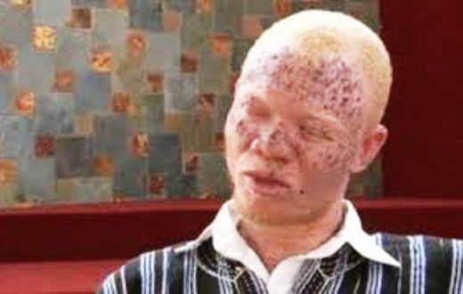114 albinos have disappeared in Mozambique