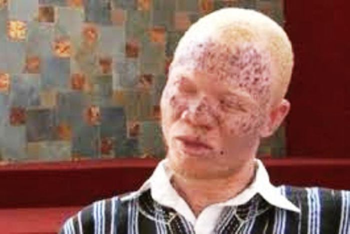 114 albinos have disappeared in Mozambique