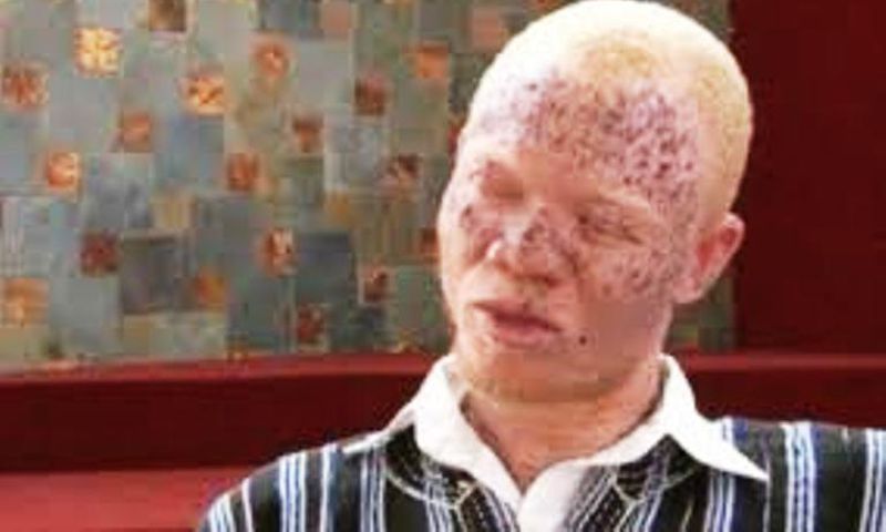 114 albinos have disappeared in Mozambique