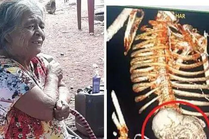Woman carries dead foetus for 56 years, dies after removal surgery