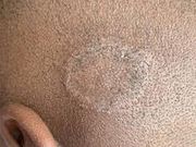 A child with a scalp ring worm