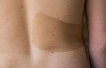 Back birthmark [RealSelfcom]