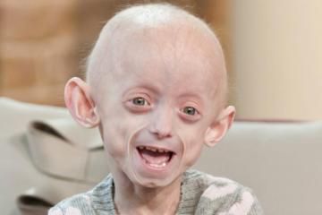 A child with Hutchinson-Gilford Progeria Syndrome [TheTimes]