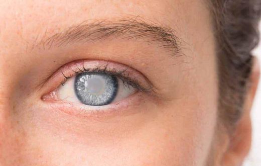 Cataract