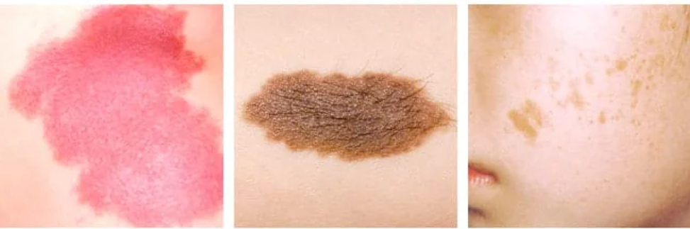 Pigmented birthmarks [PremierClinic]