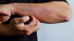 Scaly skin on face derma [Derma Essentia]