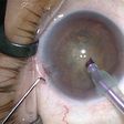 5 causes and symptoms of cataract