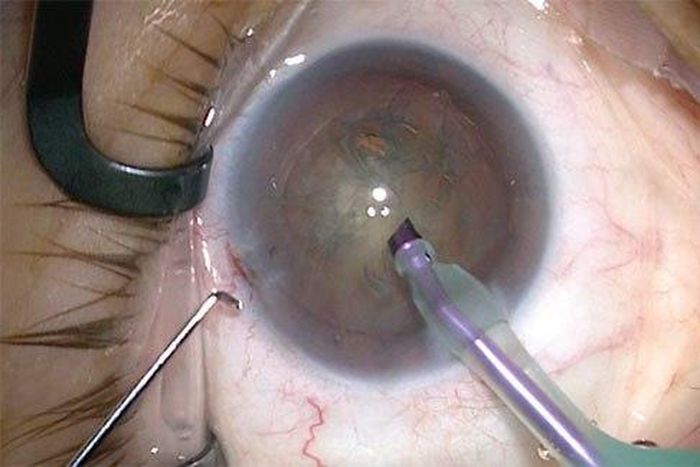 5 causes and symptoms of cataract