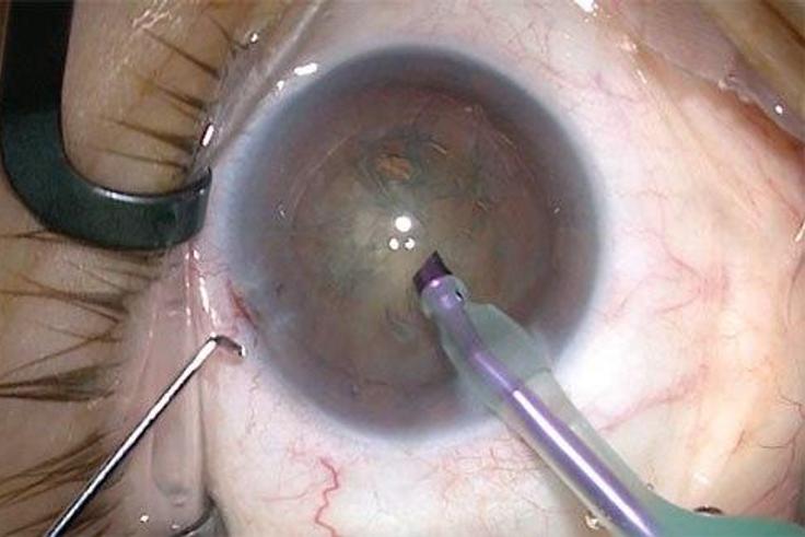 5 causes and symptoms of cataract