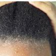 Dandruff