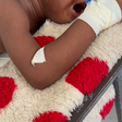Toddler attacked by dog battles for survival, needs GHC2,700 weekly for treatment