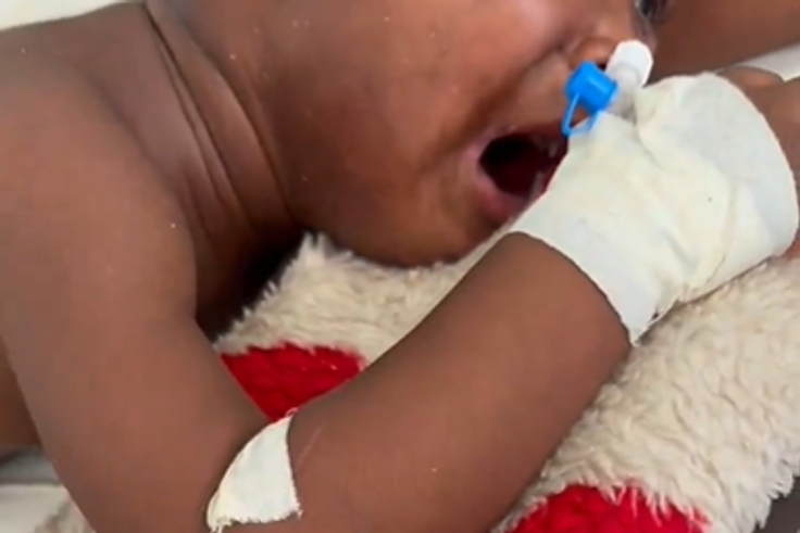 Toddler attacked by dog battles for survival, needs GHC2,700 weekly for treatment