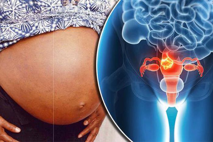 How do fibroids affect your getting pregnant?