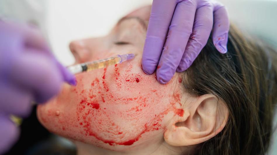 Vampire facials [businesstoday]