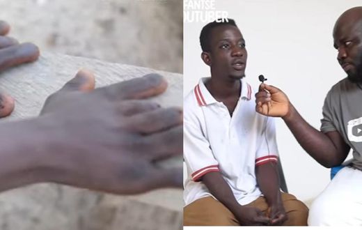 Ghanaian man who has 12 fingers, both penis and vagina begs for help