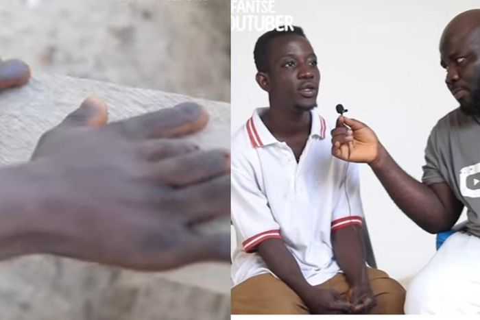 Ghanaian man who has 12 fingers, both penis and vagina begs for help
